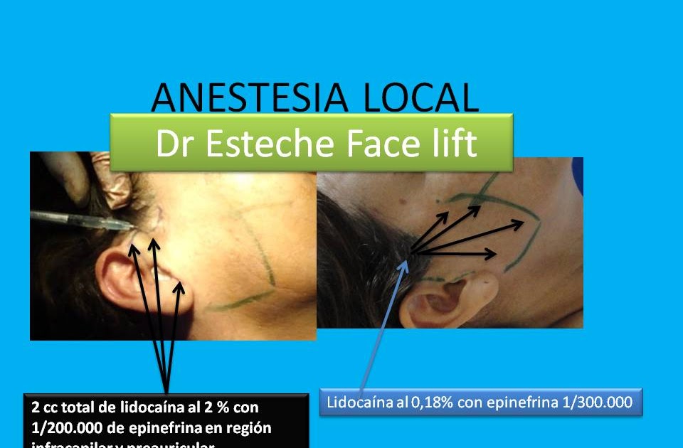 Dr.Esteche Cirugía Plástica Facial Cirugía Facial 10. "FACE LIFT