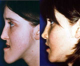 The Pros and Cons of Getting Cosmetic Surgery