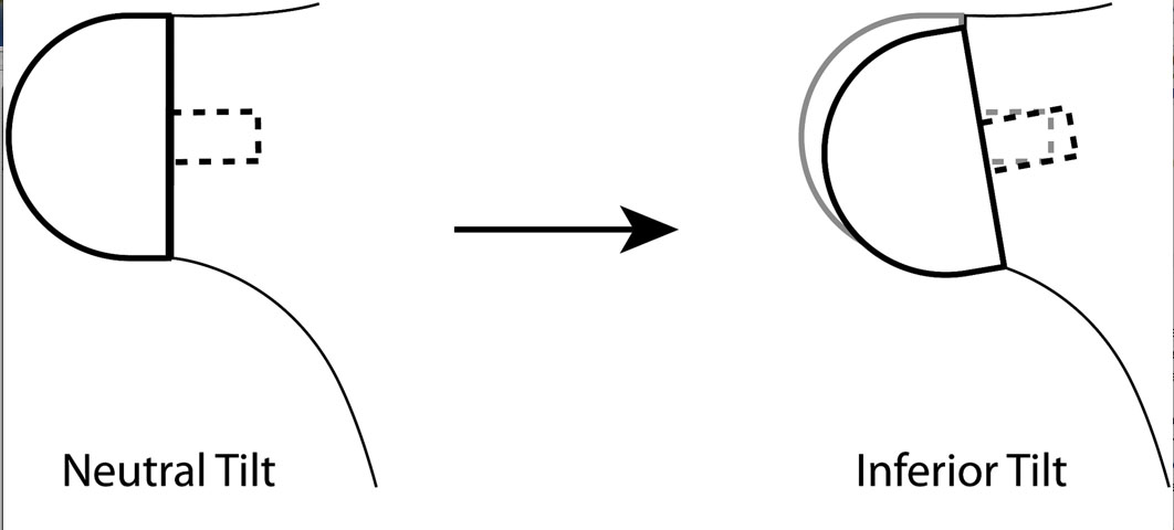 reverse shoulder prothesis reverse shoulder prothesis