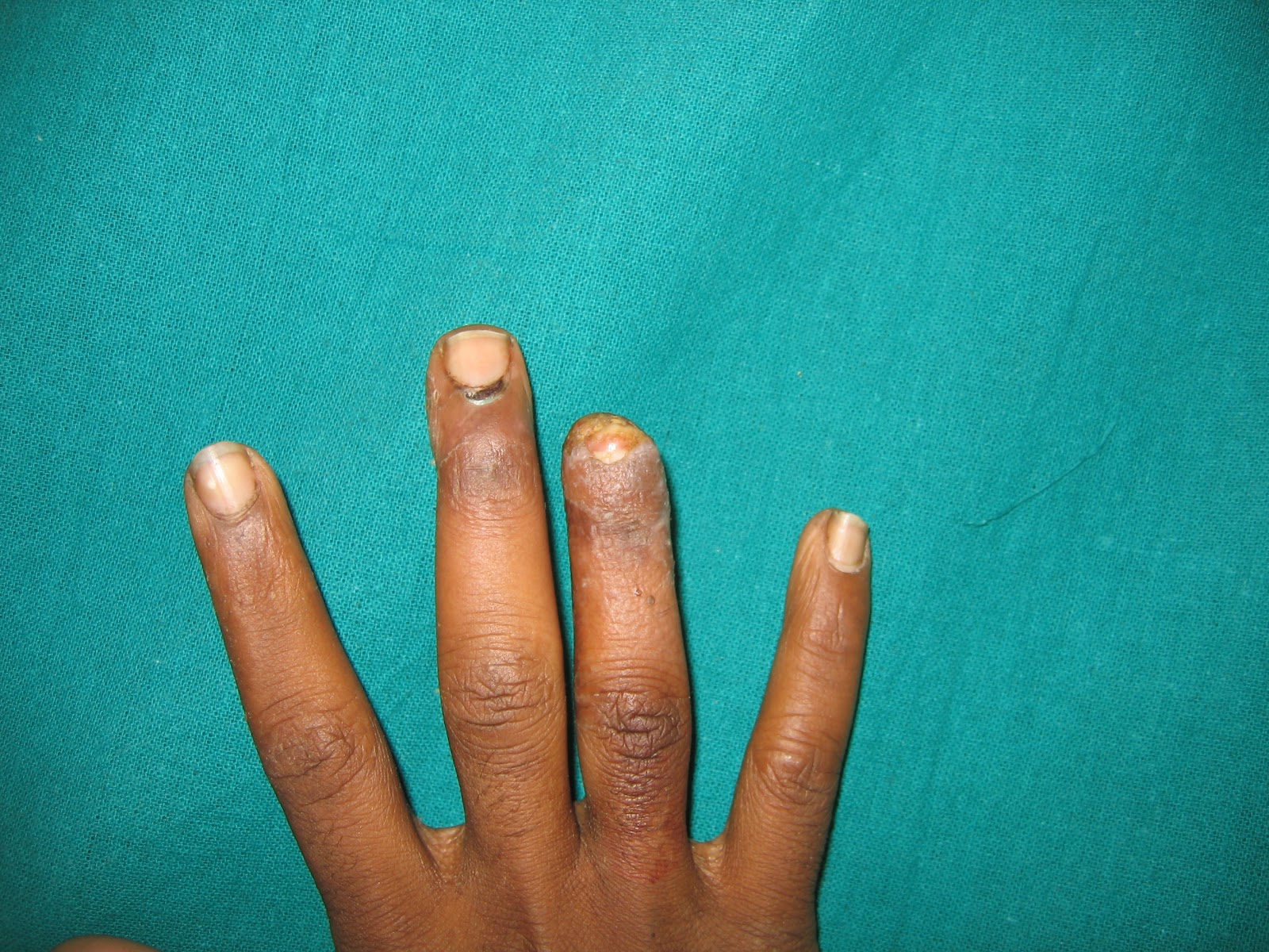 CRUSH INJURIES OF HAND AND UPPER LIMB INJURIES HAND TRAUMA FINGER TIP