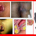 Obat Wasir Selain Venaron di Apotik Herbal thumbnail