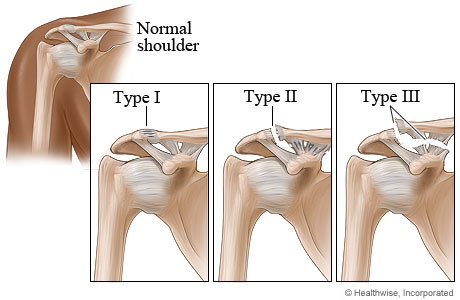 Ac Sprain