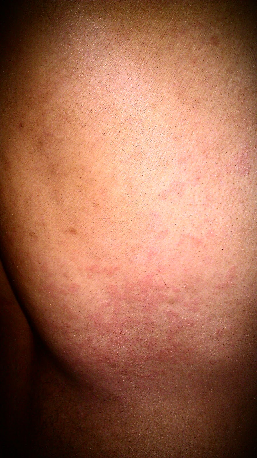 Look like bed does what tanning rash Contact dermatitis
