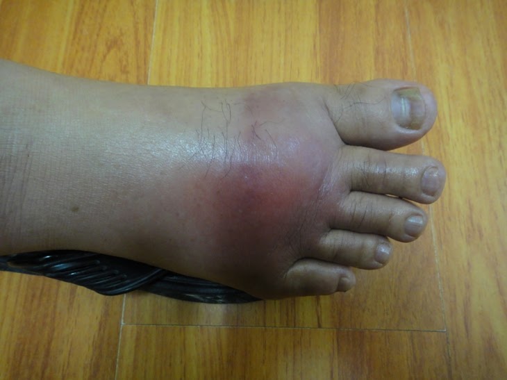 CaRIng and CaREfRee: Gout and Secondary Cellulitis
