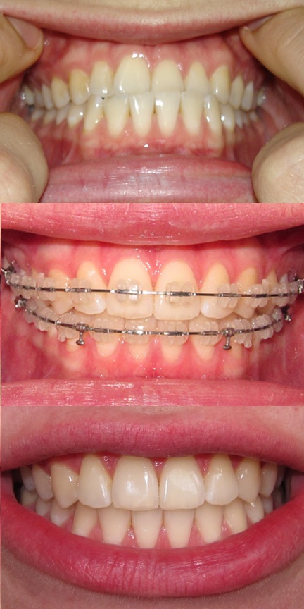 braces before underbite during fixed ceramic say