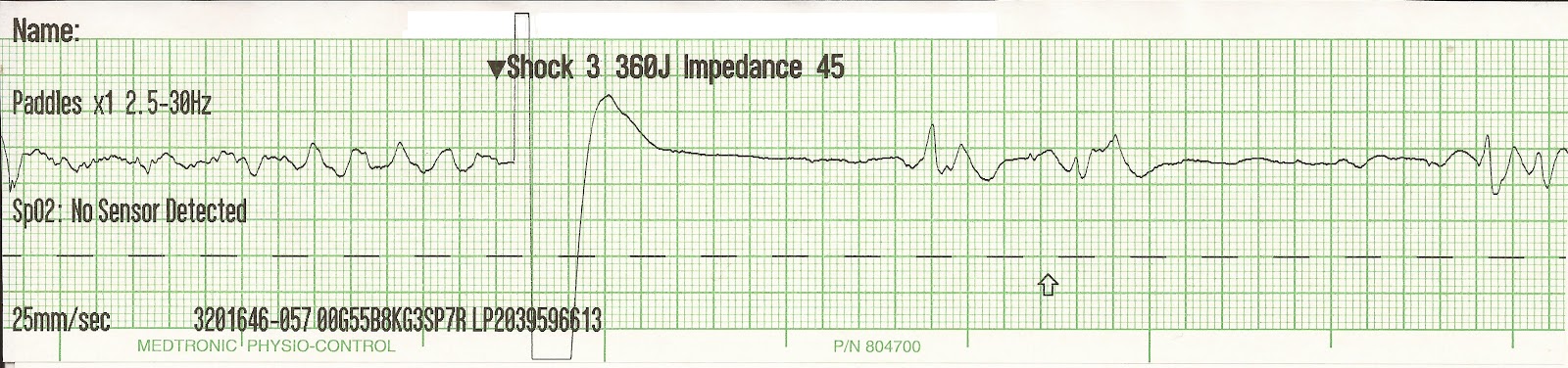 Sotalol Atrial Fibrillation Cardioversion