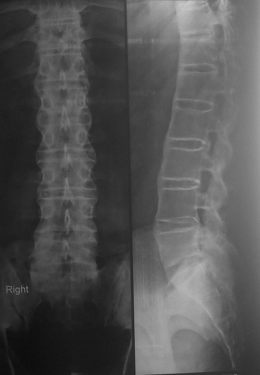 RESPIRATORY DISEASES by Dr. SHIV RAJ SHARMA X ray of spine