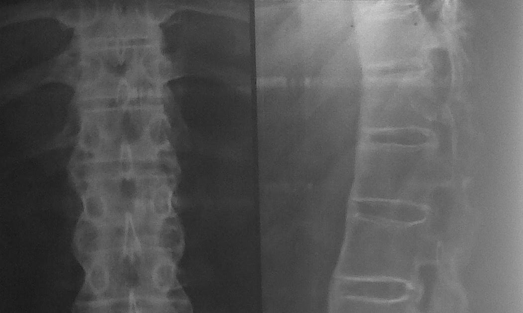RESPIRATORY DISEASES by Dr. SHIV RAJ SHARMA X ray of spine