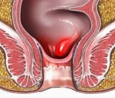 wasir obat wasir
