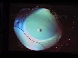 Lente IntraOcular inyectada por una incisión de 2,7 mm - Año 2010