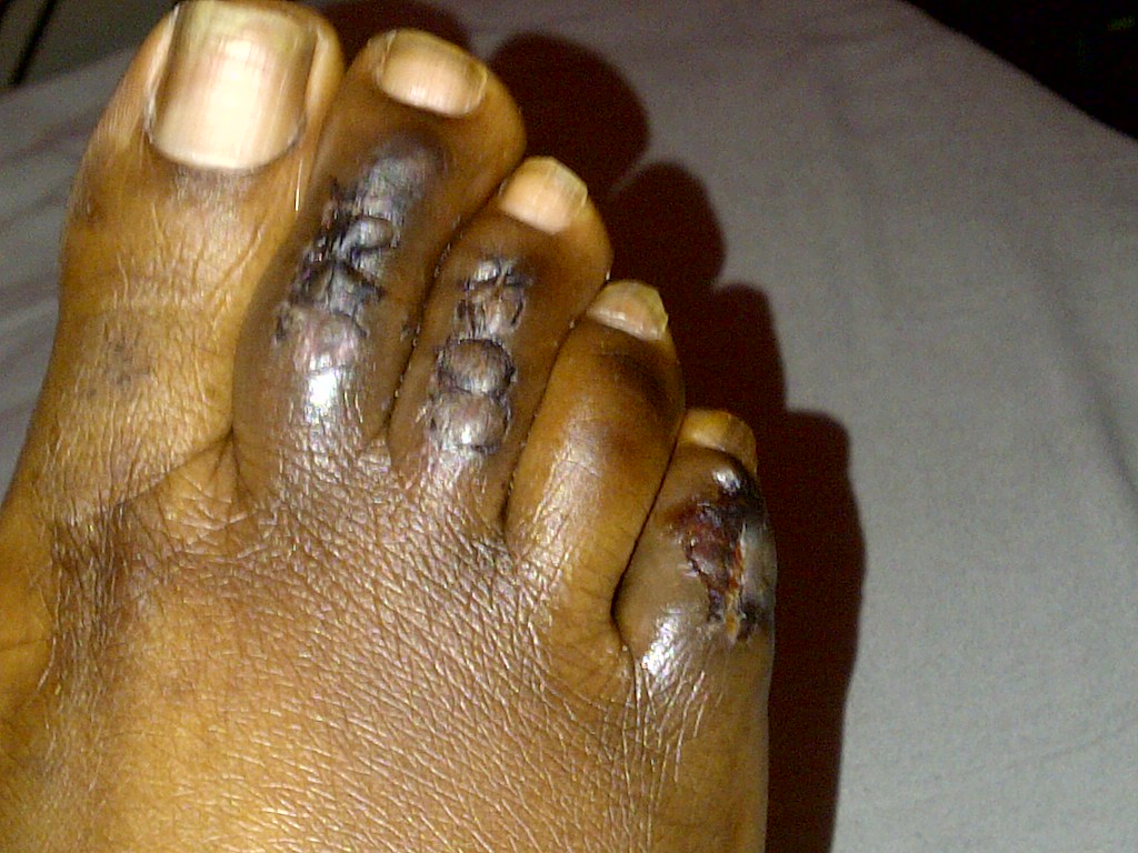 hammertoe skeletal mature Hammertoe skeletal mature