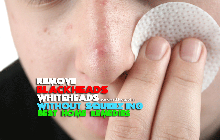 Remove Blackheads without squeezing 18 Easy home remedies for Blackheads, Whiteheads