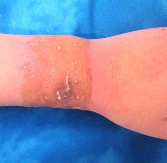 prednisone contain penicillin
