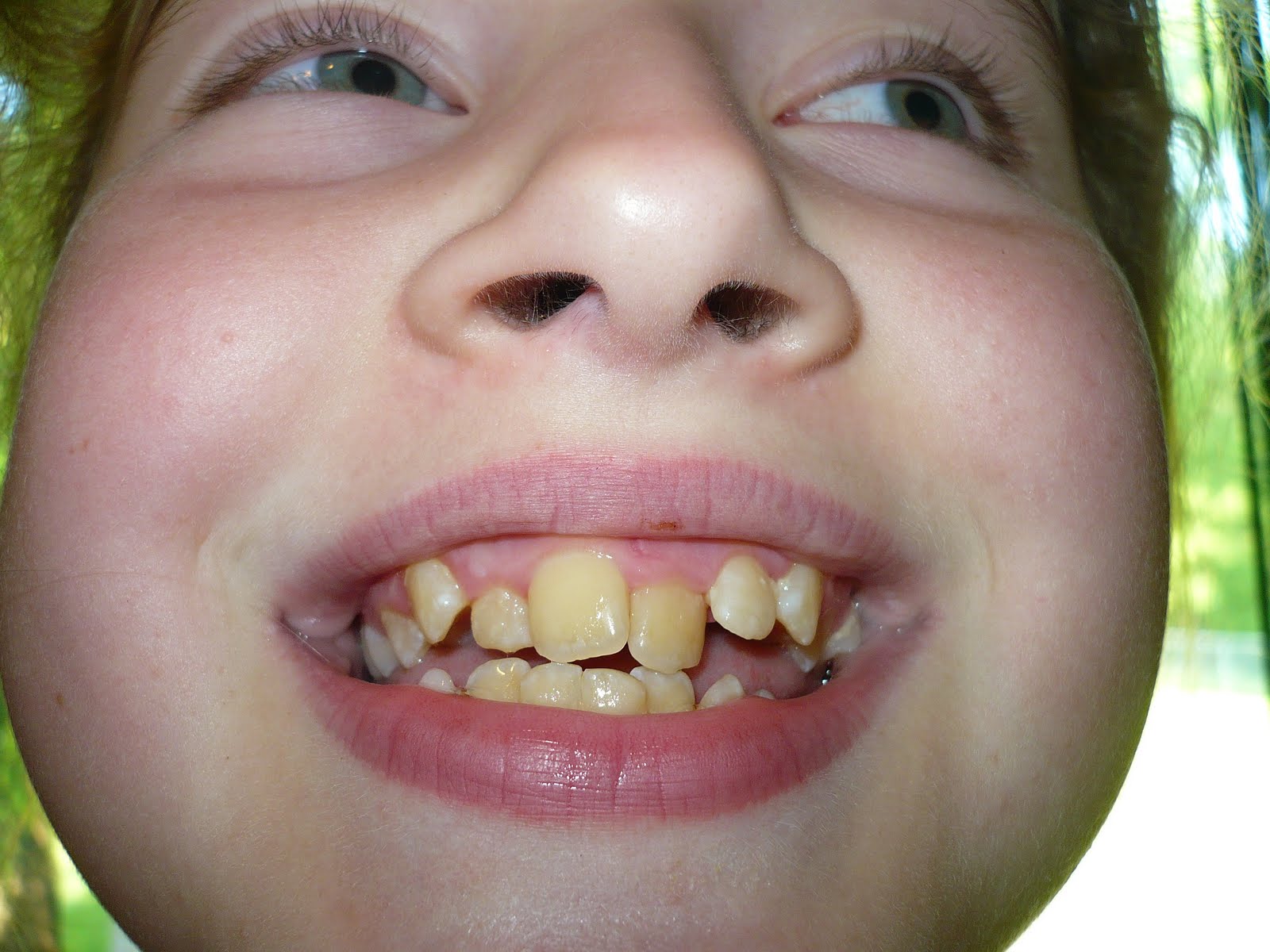 Adventures and Pics of the West Family Anne Mari's Braces Journey