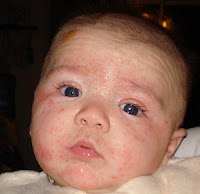 Mencegah Alergi Pada Bayi