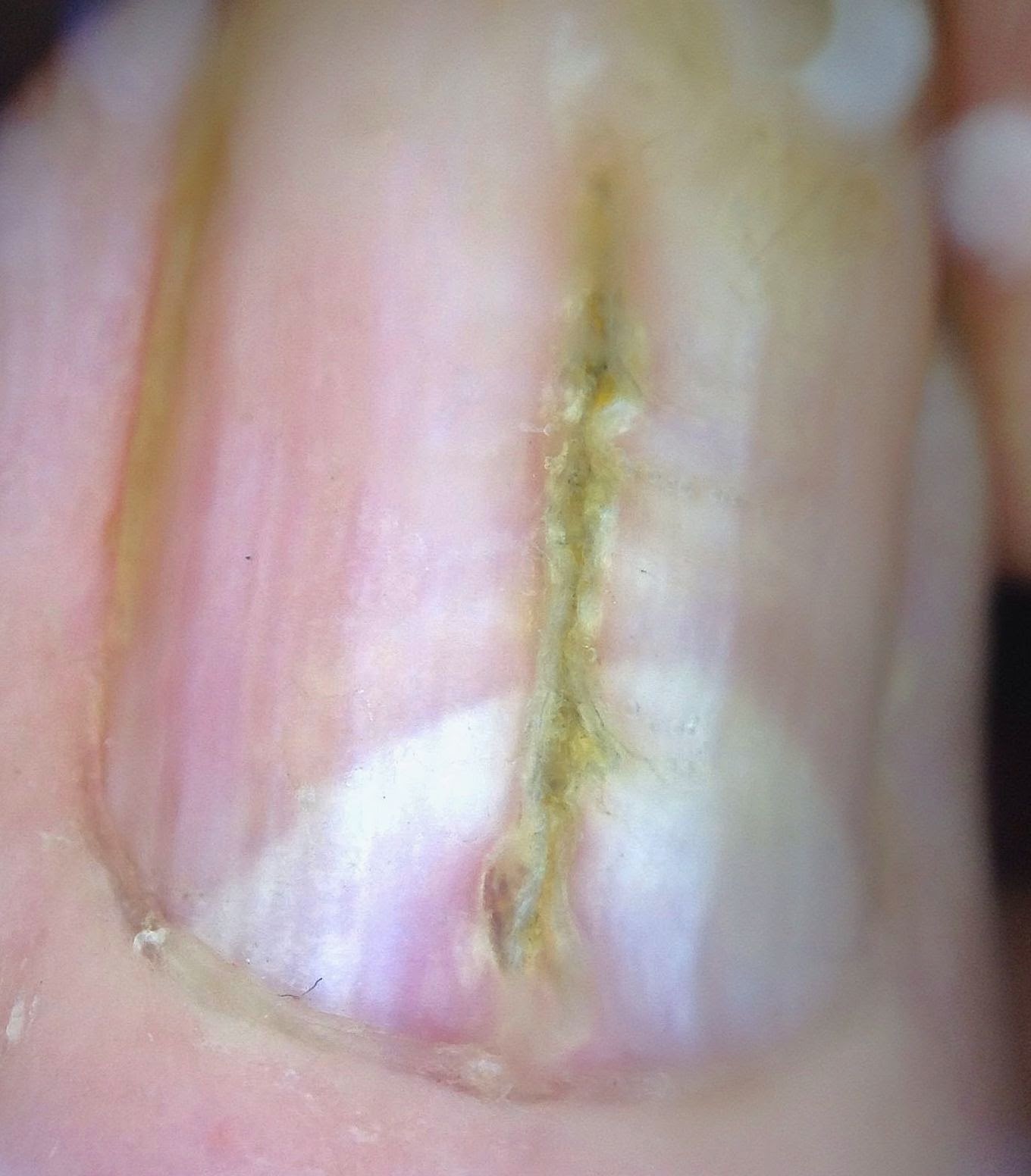 VIRTUAL GRAND ROUNDS IN DERMATOLOGY 2.0 Median Nail Dystrophy
