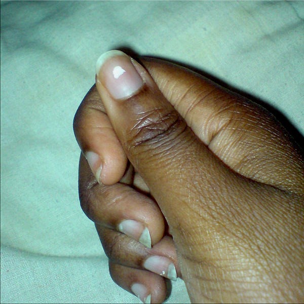 Zinc deficiency Signs and symptoms Nutrition, deficiency & diseases