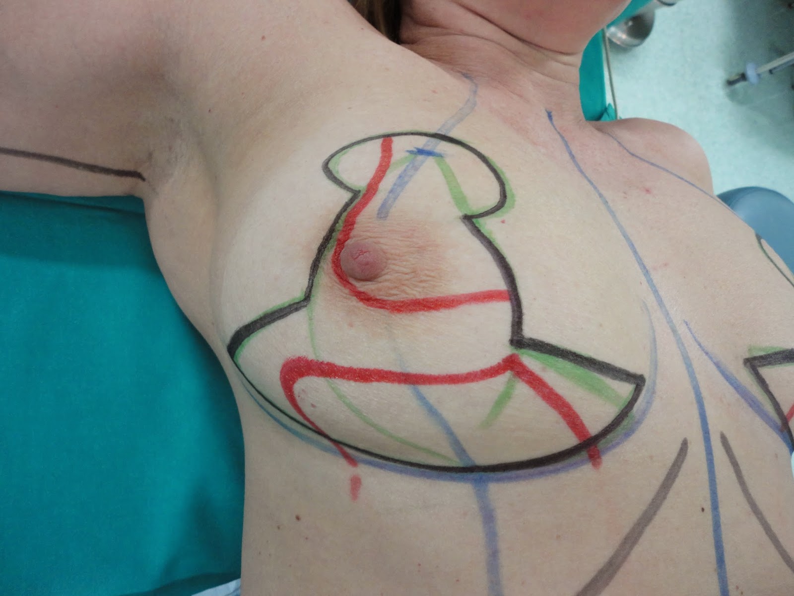 La infusión sobre los chichones del lúpulo aumenta el pecho