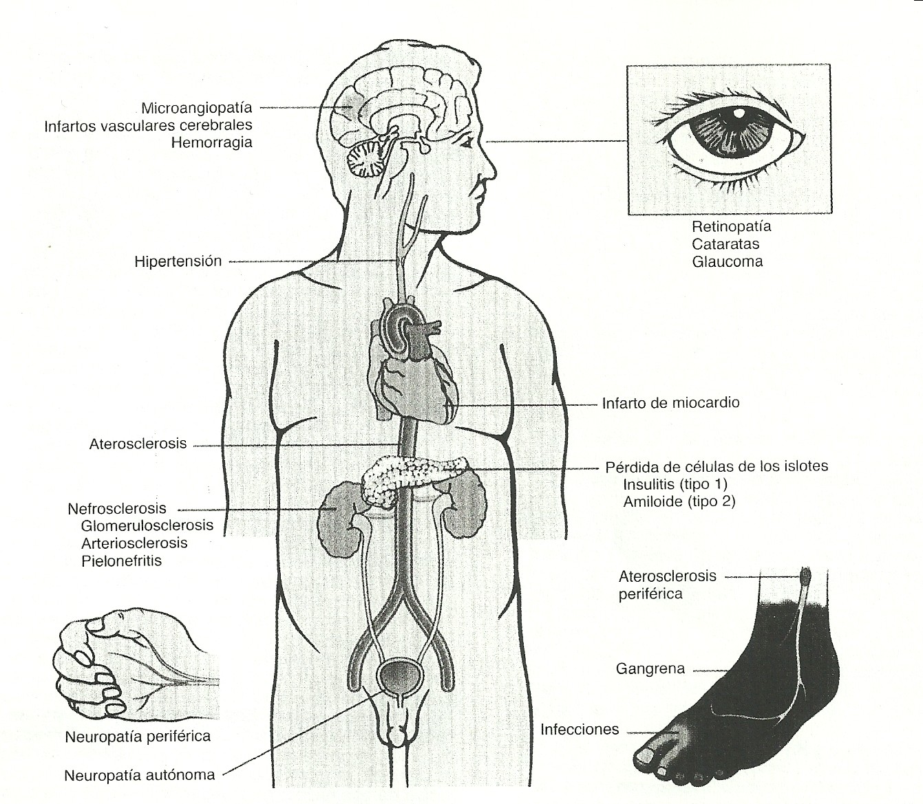 Futura médica... y algo más: DIABETES MELLITUS Futura médica... y algo más: DIABETES MELLITUS