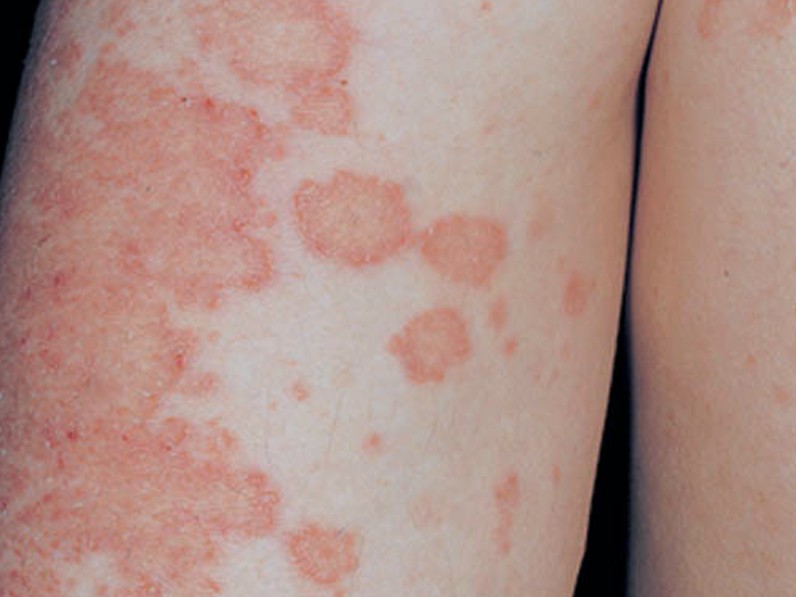 The New Elizabethans Skin conditions Contagious & Noncontagious