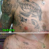 Tattoo Removal thumbnail