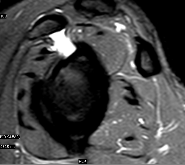 SubcoracoidSubscapularis Bursa MRI Sumer's Radiology Blog