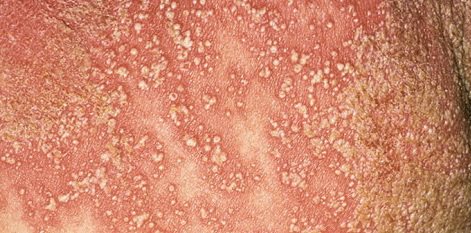 Como es curado mucho tiempo atopichesky la dermatitis a los niños