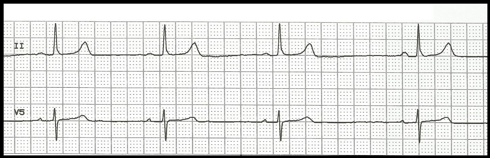 Bradycardia