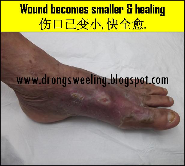 TCM News: TCM cure diabetic wound on the leg