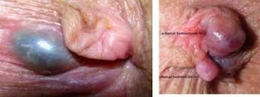 wasir obat wasir alami