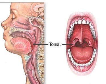 Adenoid Face Pictures : Treating Tonsil Stones - No Tonsillectomy Required!
