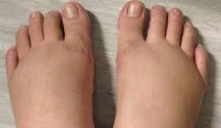Cara Atasi Kaki Bengkak Saat Hamil Cara Atasi Kaki Bengkak Saat Hamil