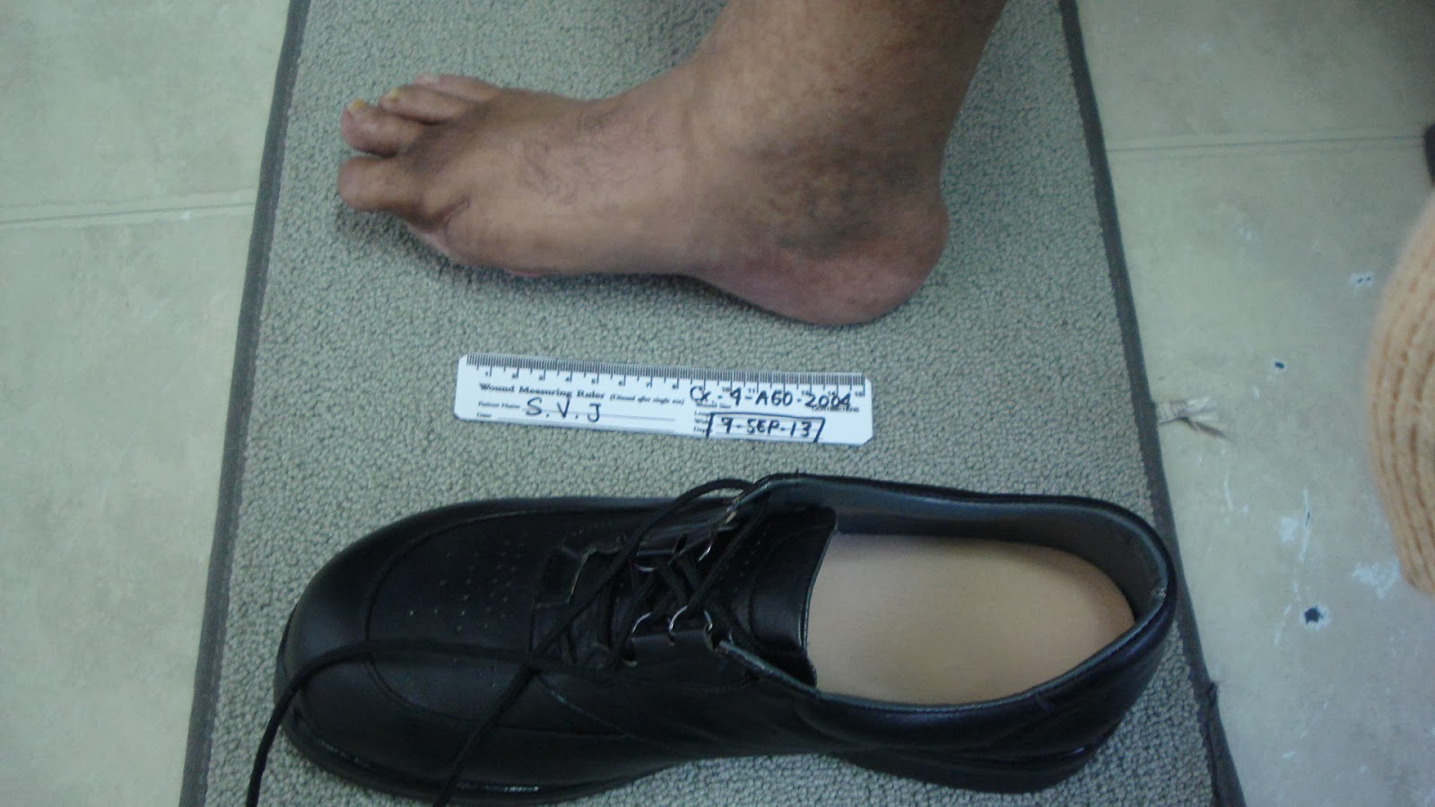 Diabetes Mellitus Calzado Pie Diabetico Calzado Pie Diabetico