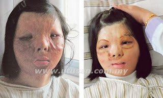 Kulit Muka Dibaiki Guna Kulit Dada Kulit Muka Dibaiki Guna Kulit Dada