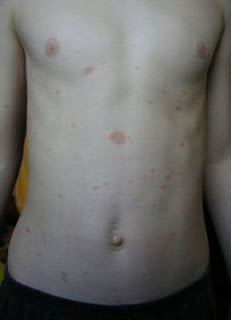 Maladie de Pityriasis rosé de Gibert Le Maladie de Pityriasis rosé de Gibert (qui tient son nom de Camille-Melchior Gibert) est une maladie dermatologique fréquente, caractérisée par dermatose érythémato-squameuse. Clinique Cette dermatose d'évolution cyclique en 6 semaines, de pronostic toujours bénin, d'apparition saisonnière (printemps-automne), chez des jeunes (entre 15 et 30 ans) le plus