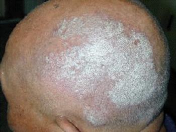 Dog Dandruff Foods Dog Dandruff Foods