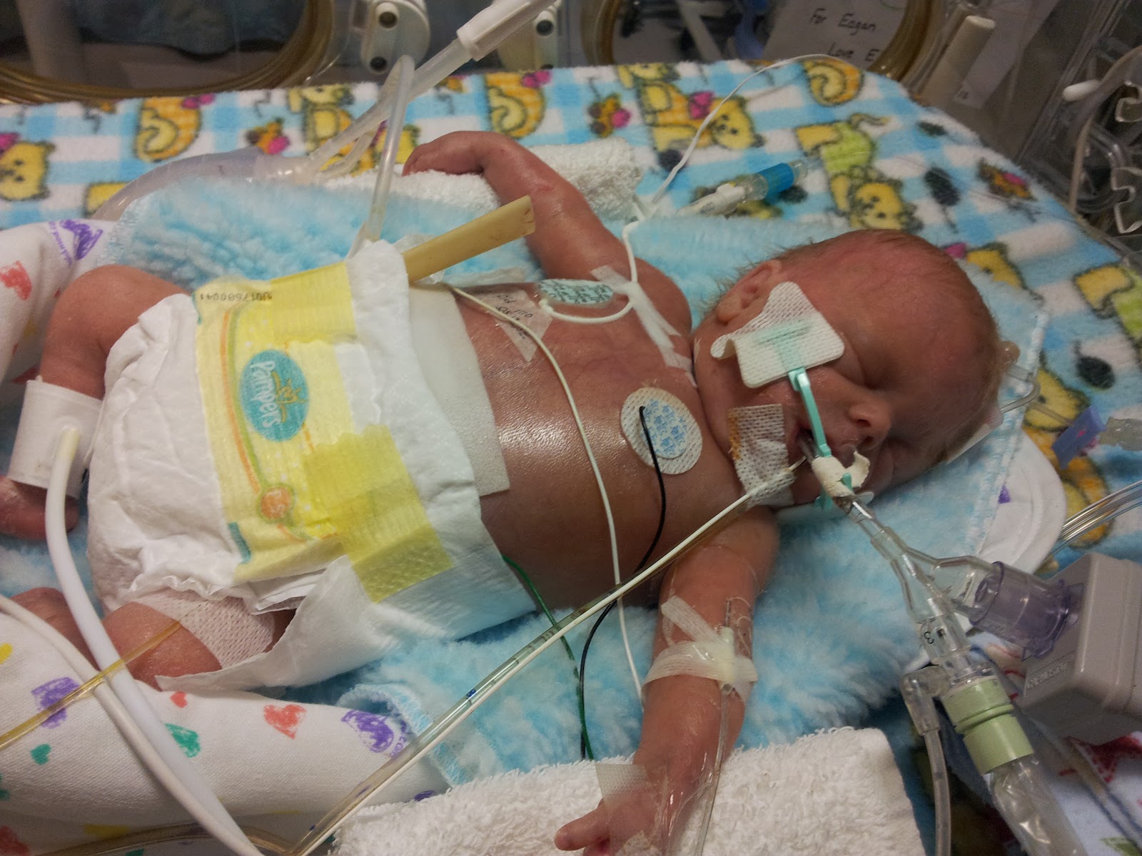 A Three E Circus Baby Eagan NICU Day 32 Third Surgery