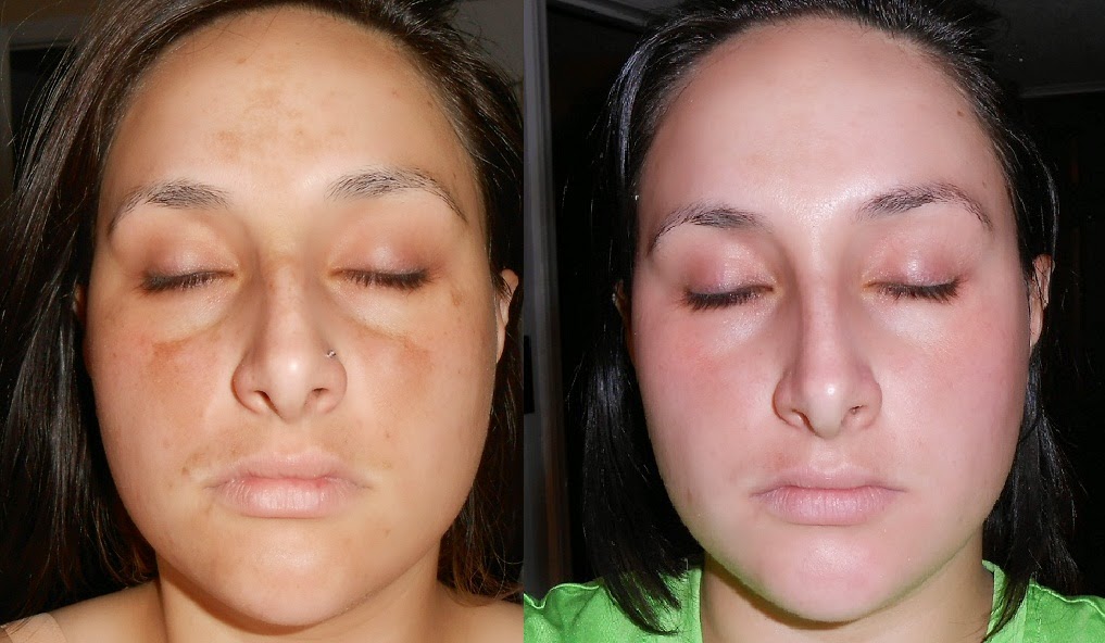 retin a cream before and after