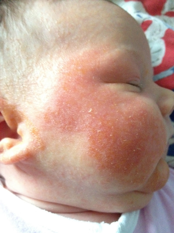 Iggy Frank and Friends Cradle cap!!!! On your face?!?!?!?!?!?