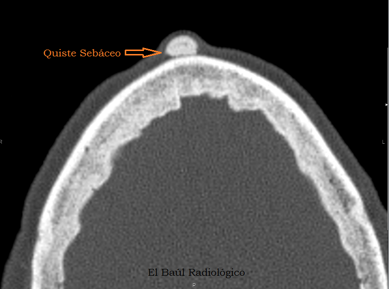 QUISTES SEBÁCEOS CALCIFICADOS DEL CUERO CABELLUDO (CALCIFIED SEBACEOUS