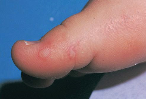 gale aux pieds gale aux pieds
