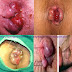 Obat Herbal Ambeclear Ampuh Mengobati Wasir Bengkak thumbnail