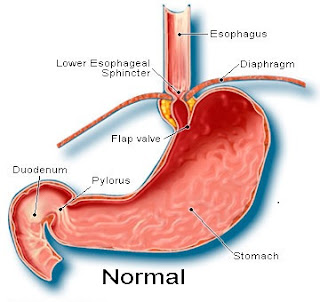 hiatal hernia - DriverLayer Search Engine
