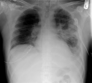 "XR chest - pneumonia with abscess and caverns - d0" by Christaras A - Converted from anonymized dicom image. Licensed under CC BY 2.5 via Wikimedia Commons - https://commons.wikimedia.org/wiki/File:XR_chest_-_pneumonia_with_abscess_and_caverns_-_d0.jpg#/media/File:XR_chest_-_pneumonia_with_abscess_and_caverns_-_d0.jpg "XR chest - pneumonia with abscess and caverns - d0" by Christaras A - Converted from anonymized dicom image. Licensed under CC BY 2.5 via Wikimedia Commons - https://commons.wikimedia.org/wiki/File:XR_chest_-_pneumonia_with_abscess_and_caverns_-_d0.jpg#/media/File:XR_chest_-_pneumonia_with_abscess_and_caverns_-_d0.jpg