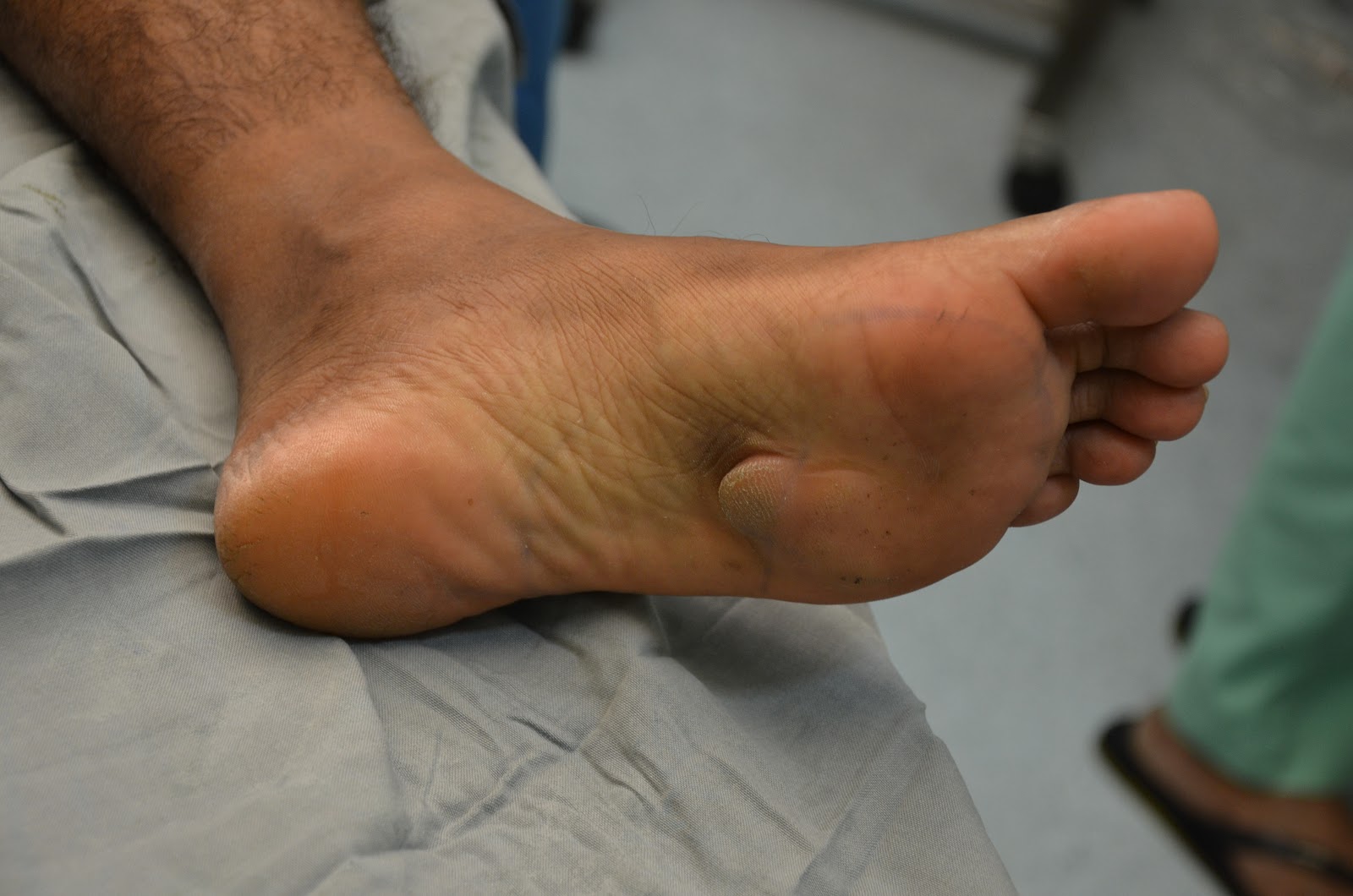 RARE SOFT TISSUE TUMOR FOOT PARAOID HYDRADENOMA EXCISION AND