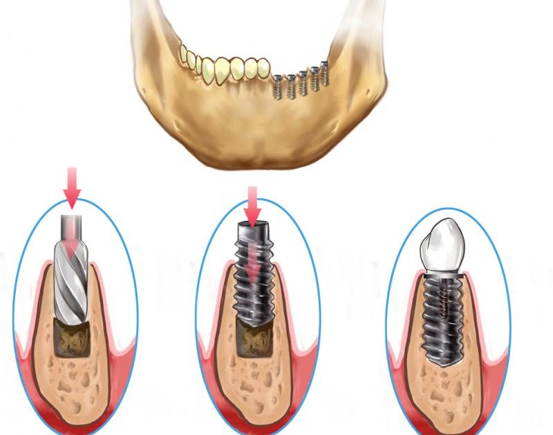 Dental implant Instructions for Placement of Dental Implants Intra