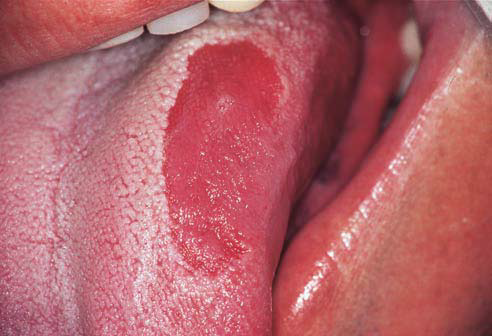 Smooth Red Sore Patch On Tongue