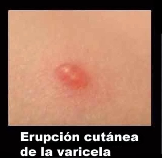 El tratamiento real de la psoriasis por los medios públicos