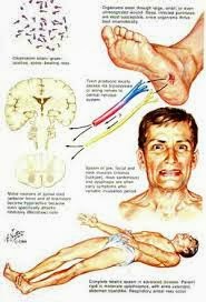 Cara Mengobati Penyakit Tetanus Secara Alami Cara Mengobati Penyakit Tetanus Secara Alami