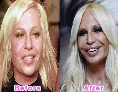 plastic surgery gone wrong
